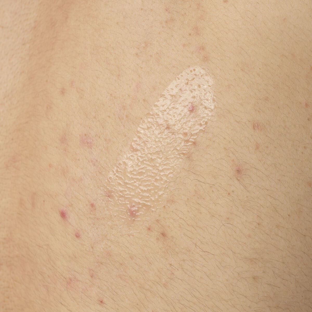 salicylic-acid-0-5-body-serum-e0 ORD-salicylic-acid-05-body-240ml-application.jpg