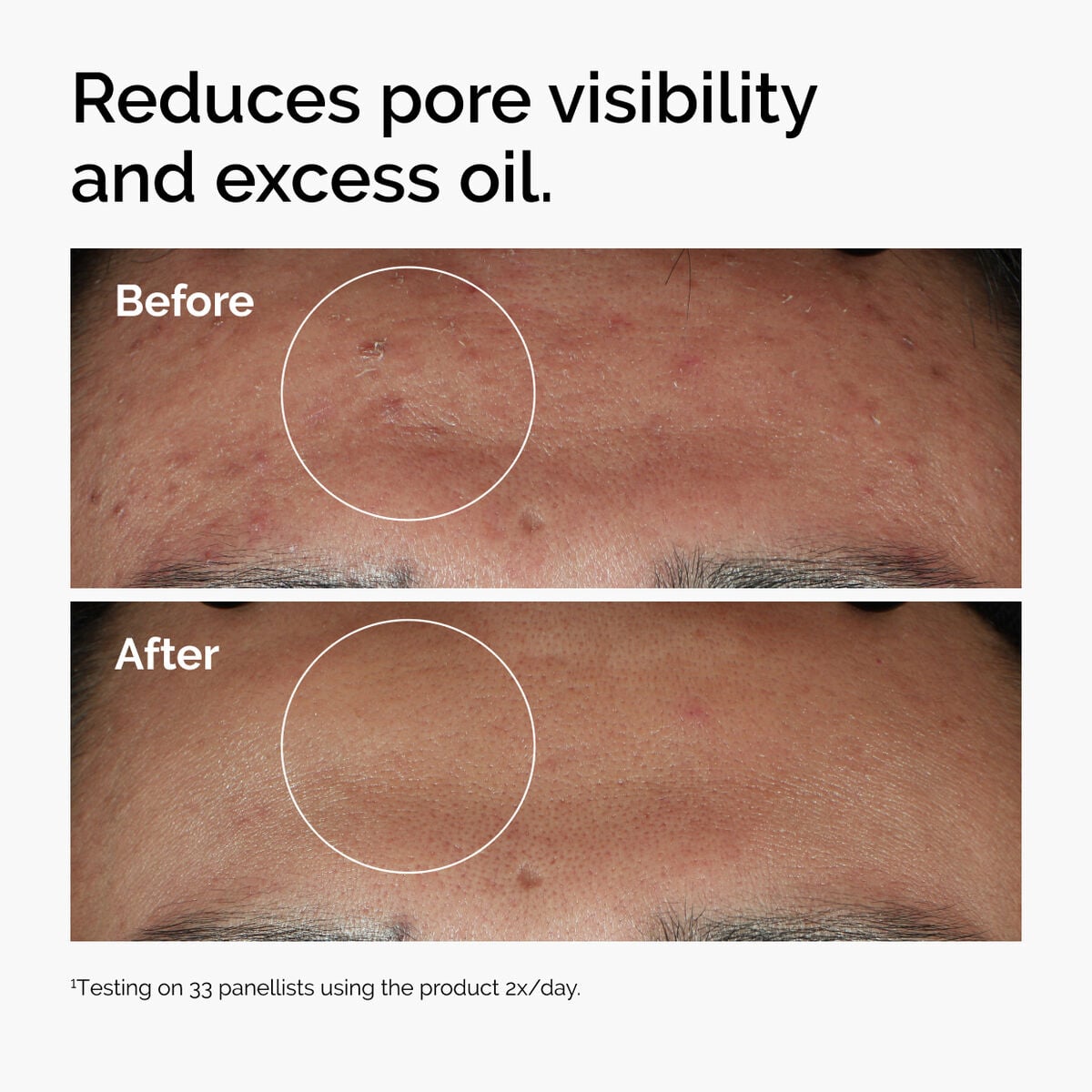 niacinamide-10-zinc-1-e4 ord-niacinamide-zinc-blemish-serum-before-after-pores.jpg