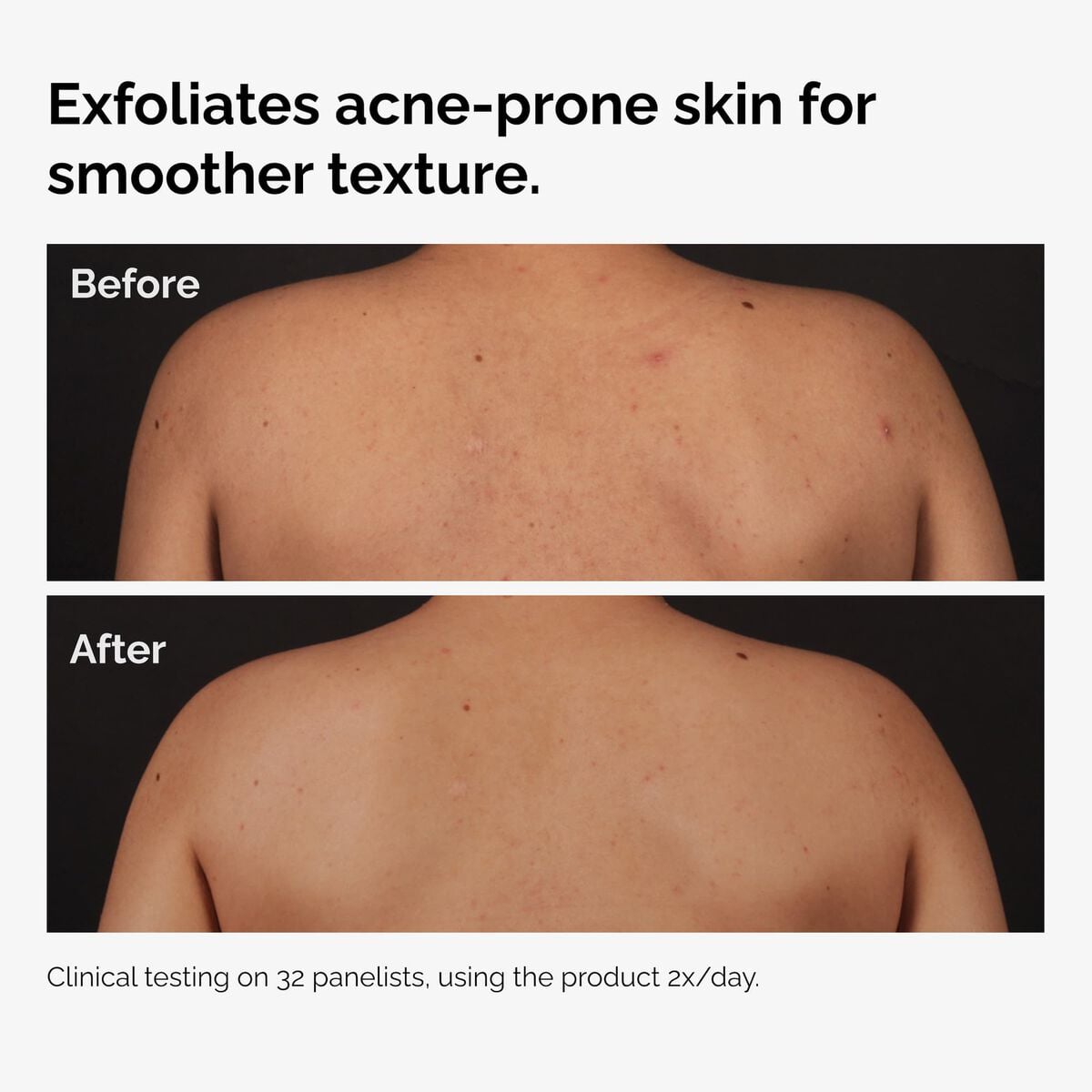 salicylic-acid-0-5-body-serum-e0 ord-salicylic-acid-body-serum-before-after-graphic-NA.jpg