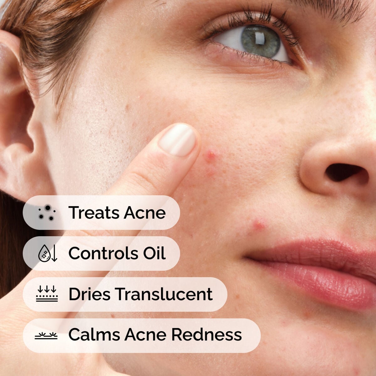 sulfur-10-powder-to-cream-concentrate-w1 ord-sulfur-10pct-powder-to-cream-concentrate-model-application-with-benefits-acne.jpg