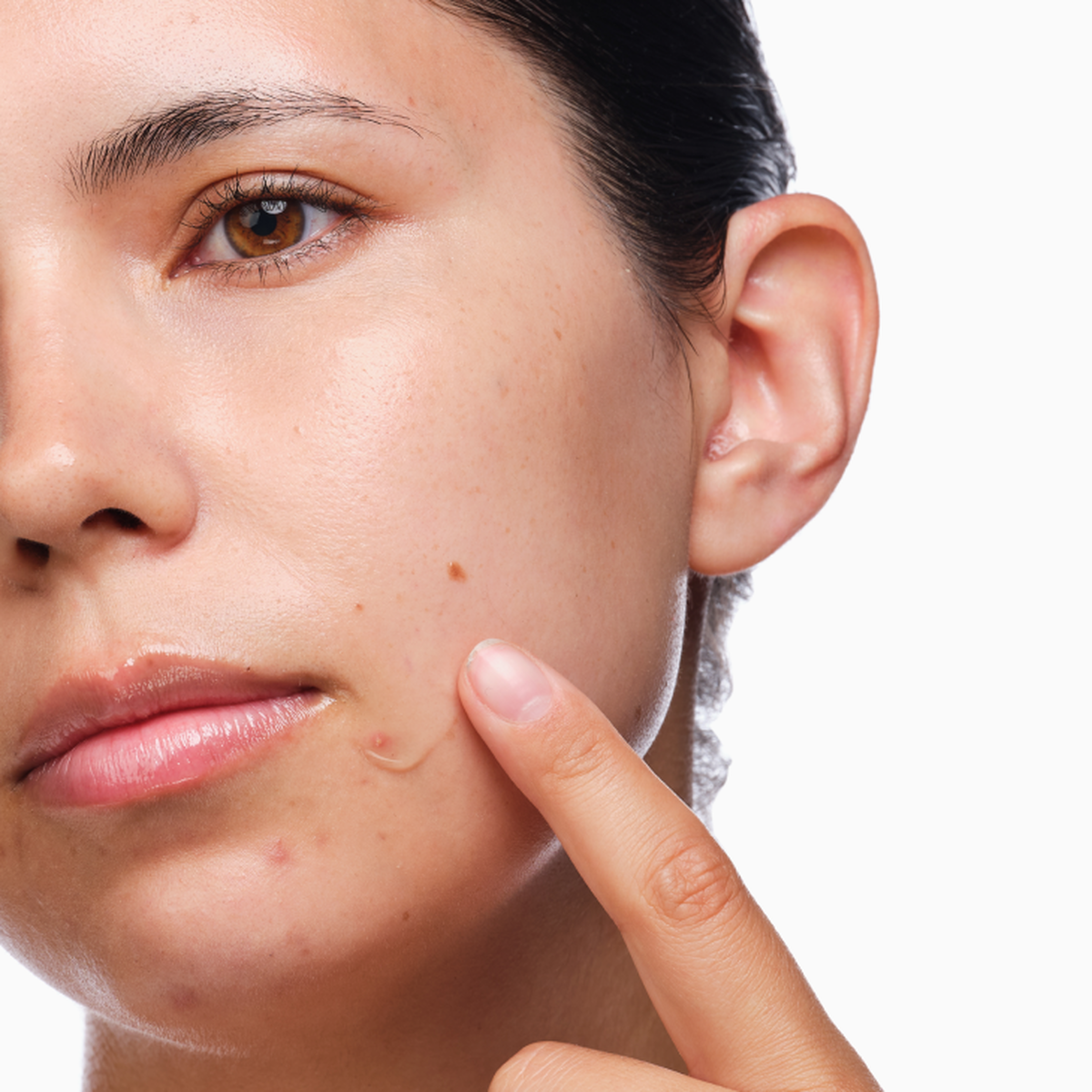 the-acne-set-t3 rdn-the-acne-set-application.png